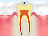 C0 【ごく初期の虫歯】