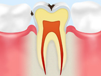 C1 【エナメル質の虫歯】