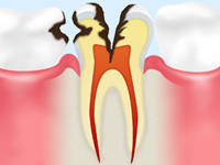 C3 【神経まで達した虫歯】