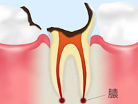 C4 【歯根まで達した虫歯】