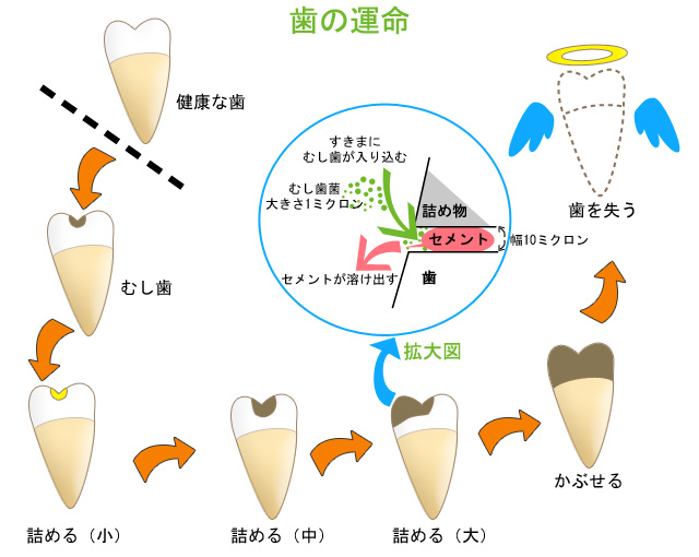 歯の運命